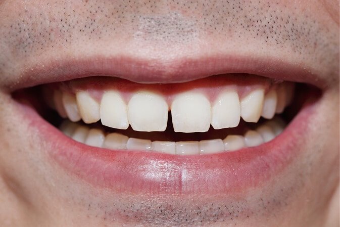 רווח בשיניים לפני ציפוי חרסינה